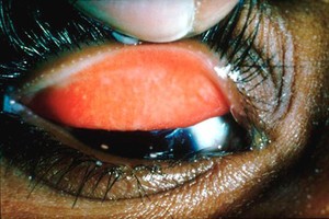 view Trachoma WHO grade: trachomatous inflammation - intense (TI)