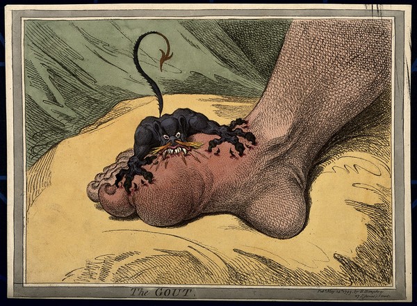 A swollen and inflamed foot: gout is represented by an attacking demon. Coloured soft-ground etching by J. Gillray, 1799.