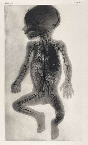 An injected arterial vessel system of a 9 month old foetus. Collotype by Römmler & Jonas after a radiograph made for G. Leopold and Th. Leisewitz, 1908.