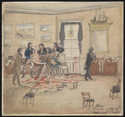 A surgical operation to remove a malignant tumour from a man's left breast and armpit in a Dublin drawing room, 1817. Watercolour, ca 1913, after a watercolour, 1817.