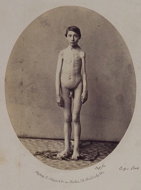 A naked young man, viewed from the front in full-length, revealing a deformity in his left arm and shoulder. Photograph by L. Haase after H.W. Berend, 1860.