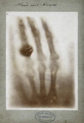 The bones of a hand with a ring on one finger, viewed through x-ray. Photoprint from radiograph by W.K. Röntgen, 1895.