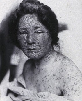 Friern Hospital, London: a woman's arms with spots, possibly smallpox. Photograph, 1890/1910.