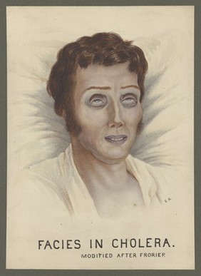 A cholera victim with a typical facial appearance. Watercolour by E. Schwarz, 1920/1950 (?), after Robert Froriep, ca. 1831.