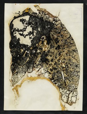 [Section of coal miner's lung showing severe pneumoconiosis] / J. Gough, J. Wentworth.