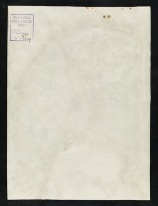 [Section of coal miner's lung showing severe pneumoconiosis] / J. Gough, J. Wentworth.