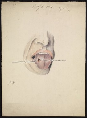 A diseased area of tissue on the tongue of a man suffering from syphilis, being held open by two small metal hooks on chains. Watercolour by C. D'Alton, 1858.