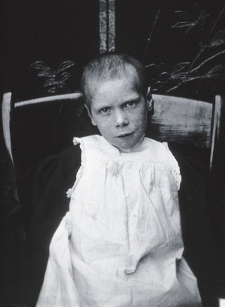 Gloucester smallpox epidemic, 1896: Edith Mills, a smallpox patient, after recovery. Photograph by H.C.F., 1896.