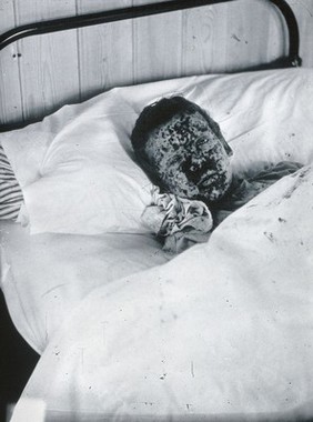 Gloucester smallpox epidemic, 1896: J.R. Evans, aged 10 years, a smallpox patient. Photograph by H.C.F., 1896.