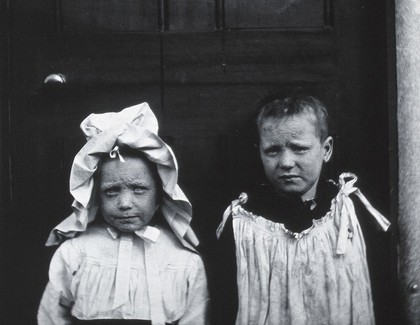 Gloucester smallpox epidemic, 1896: two convalescent children. Photograph by H.C.F., 1896.