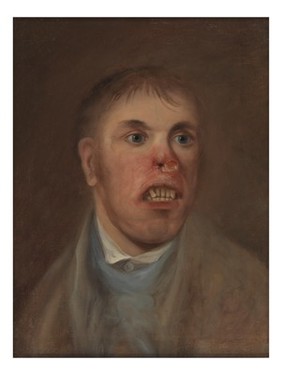 A young man, J. Kay, afflicted with a disease which has eaten away part of his face. Oil painting, ca. 1820.