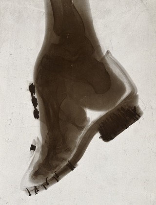 Foot of a Chinese woman, showing the effect of foot-binding. Photograph by (?) E.P. Minett, 192-.