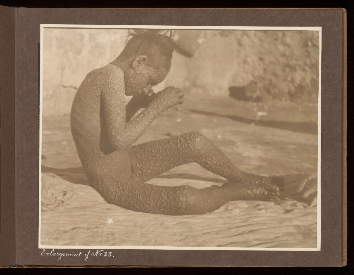 Smallpox epidemic, Palestine. Photograph album, ca. 1922.
