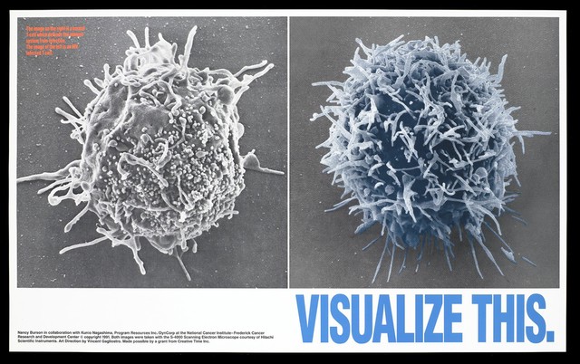 Two enlarged images of T-cells one infected with HIV by the Frederick Cancer Research and Development Center. Colour lithograph by Nancy Burson and Kunio Nagashima, 1991.