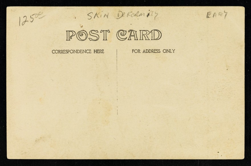 [Elephantiasis of the legs] : post card.