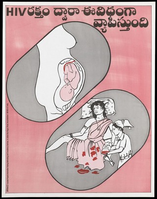 A foetus in the womb of a woman and a nurse delivering the baby below representing a warning about the dangers of passing on HIV through pregnancy by Spitnacs, Societal Projects Information Training Networking and Consultancy Services. Colour lithograph, ca 1997.