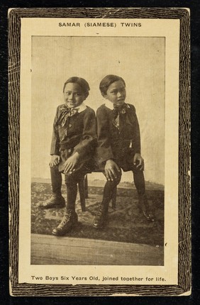 Samar (Siamese) twins : two boys six years old, joined together for life.