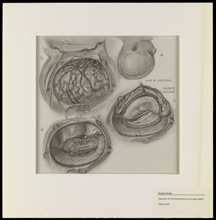 Hemispherectomy in an adult patient: four figures. Carbon dust drawing by A.J. Arnott, 1960.