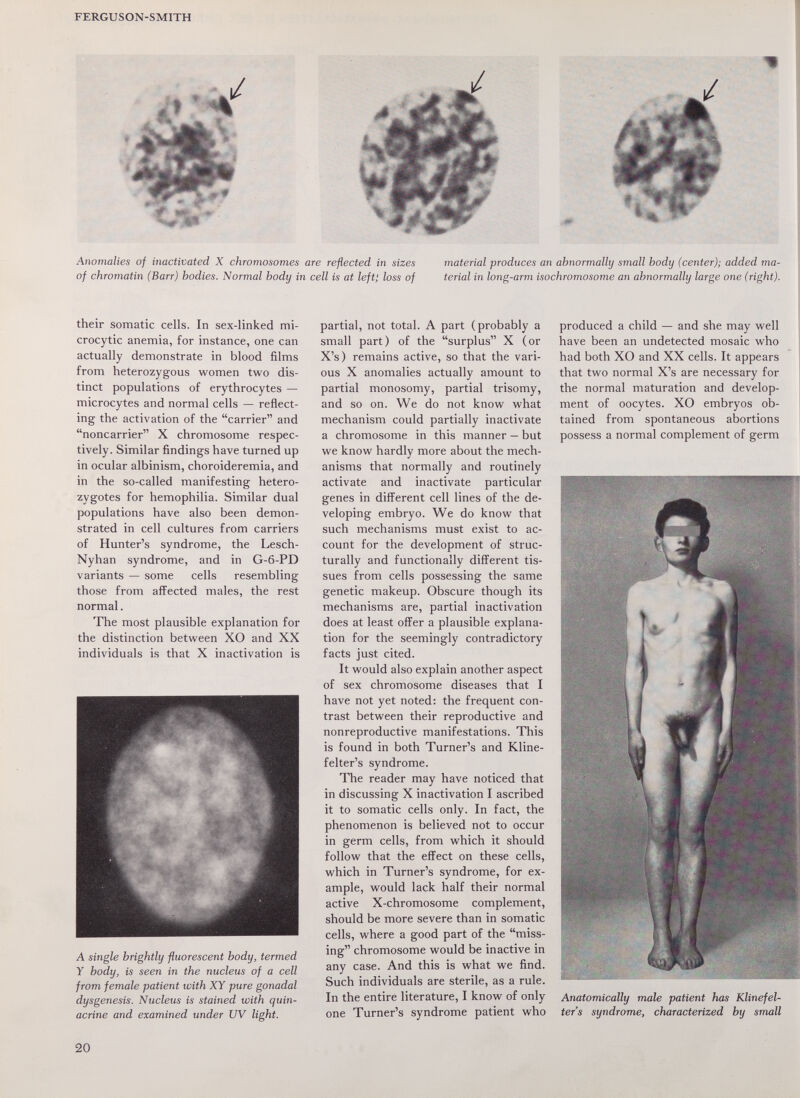 FERGUSON-SMITH Anomalies of inactivated X chromosomes are reflected in sizes material produces an abnormally small body (center); added ma- of chromatin (Barr) bodies. Normal body in cell is at left; loss of terial in long-arm isochromosome an abnormally large one (right). their somatic cells. In sex-linked mi¬ crocytic anemia, for instance, one can actually demonstrate in blood films from heterozygous women two dis¬ tinct populations of erythrocytes — microcytes and normal cells — reflect¬ ing the activation of the carrier and noncarrier X chromosome respec¬ tively. Similar findings have turned up in ocular albinism, choroideremia, and in the so-called manifesting hetero¬ zygotes for hemophilia. Similar dual populations have also been demon¬ strated in cell cultures from carriers of Hunter's syndrome, the Lesch- Nyhan syndrome, and in G-6-PD variants — some cells resembling those from afl^ected males, the rest normal. The most plausible explanation for the distinction between XO and XX individuals is that X inactivation is A single brightly fluorescent body, termed Y body, is seen in the nucleus of a cell from female patient with XY pure gonadal dysgenesis. Nucleus is stained with quin- acrine and examined under UV light. partial, not total. A part (probably a small part) of the surplus X (or X's) remains active, so that the vari¬ ous X anomalies actually amount to partial monosomy, partial trisomy, and so on. We do not know what mechanism could partially inactivate a chromosome in this manner — but we know hardly more about the mech¬ anisms that normally and routinely activate and inactivate particular genes in different cell lines of the de¬ veloping embryo. We do know that such mechanisms must exist to ac¬ count for the development of struc¬ turally and functionally different tis¬ sues from cells possessing the same genetic makeup. Obscure though its mechanisms are, partial inactivation does at least offer a plausible explana¬ tion for the seemingly contradictory facts just cited. It would also explain another aspect of sex chromosome diseases that I have not yet noted: the frequent con¬ trast between their reproductive and nonreproductive manifestations. This is found in both Turner's and Kline- felter's syndrome. The reader may have noticed that in discussing X inactivation I ascribed it to somatic cells only. In fact, the phenomenon is believed not to occur in germ cells, from which it should follow that the effect on these cells, which in Turner's syndrome, for ex¬ ample, would lack half their normal active X-chromosome complement, should be more severe than in somatic cells, where a good part of the miss¬ ing chromosome would be inactive in any case. And this is what we find. Such individuals are sterile, as a rule. In the entire literature, I know of only one Turner's syndrome patient who produced a child — and she may well have been an undetected mosaic who had both XO and XX cells. It appears that two normal X's are necessary for the normal maturation and develop¬ ment of oocytes. XO embryos ob¬ tained from spontaneous abortions possess a normal complement of germ Anatomically male patient has Klinefel¬ ter's syndrome, characterized by small 20