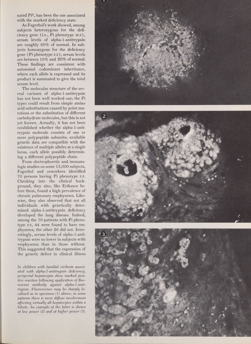 nated Pi''', has been the one associated with the marked deficiency state. As Fagerhol's work showed, among subjects heterozygous for the defi¬ ciency gene (i.e.. Pi phenotype Mz), serum levels of alpha-1-antitrypsin are roughly 60% of normal. In sub¬ jects homozygous for the deficiency gene ( Pi phenotype z z ), serum levels are between 10% and 20% of normal. These findings are consistent with autosomal codominant inheritance, where each allele is expressed and its product is summated to give the total serum level. The molecular structure of the sev¬ eral variants of alpha-1-antitrypsin has not been well worked out; the Pi types could result from simple amino acid substitutions caused by point mu¬ tations or the substitution of different carbohydrate molecules, but this is not yet known. Actually, it has not been established whether the alpha-1-anti¬ trypsin molecule consists of one or more polypeptide subunits; available genetic data are compatible with the existence of multiple alleles at a single locus, each allele possibly determin¬ ing a different polypeptide chain. From electrophoretic and immuno¬ logic studies on some 13,000 subjects, Fagerhol and coworkers identified 70 persons having Pi phenotype zz. Checking into the clinical back¬ ground, they also, like Eriksson be¬ fore them, found a high prevalence of chronic pulmonary emphysema. Like¬ wise, they also observed that not all individuals with genetically deter¬ mined alpha-1-antitrypsin deficiency developed the lung disease. Indeed, among the 70 patients with Pi pheno¬ type zz, 44 were found to have em¬ physema; the other 26 did not. Inter¬ estingly, serum levels of alpha-1-anti¬ trypsin were no lower in subjects with emphysema than in those without. This suggested that the expression of the genetic defect in clinical illness In children with familial cirrhosis associ¬ ated with alpha-l-antitrypsin deficiency, periportal hepatocytes show marked posi¬ tive reaction following application of fluo¬ rescent antibody against alpha-l-anti¬ trypsin. Fluorescence ггшу he sharply lo¬ calized as in specimen (1) above; in some patients there is more diffuse involvement affecting virtually all hepatocytes within a lobule. An example of the latter is shown at low power (2) and at higher power (3).