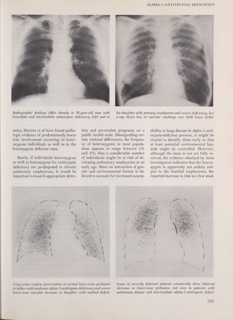 ALPHA- l-ANTITRYPSIN DEFICIENCY Radiographic findings differ sharply in 55-year-old man with bronchitis and intermediate antienzyme deficiency (left) and in sema, Stevens et al have found patho¬ logic evidence of predominantly lovi^er lobe involvement occurring in heter¬ ozygous individuals as w^ell as in the homozygous deficient ones. Surely, if individuals heterozygous as well as homozygous for antitrypsin deficiency are predisposed to chronic pulmonary emphysema, it would be important to launch appropriate detec¬ I Lung scans confirm preservation of normal lower-zone perfusion in father with moderate alpha-1-antitrypsin deficiency and severe lower-zone vascular decrease in daughter with marked deficit. his daughter with primary emphysema and severe deficiency; her x-ray shows loss of vascular markings over both lower fields. tibility to lung disease in alpha-1-anti- trypsin-deficient persons, it might be crucial to identify them early so that at least potential environmental haz¬ ards might be controlled. However, although the issue is not yet fully re¬ solved, the evidence obtained by most investigators indicates that the hetero¬ zygote is apparently not unduly sub¬ ject to the familial emphysema; the reported increase in risk in a few stud- Scans of severely deficient patients consistently show bilateral decrease in lower-zone perfusion, not seen in patients with pulmonary disease and intermediate alpha-1-antitrypsin deficit. tion and prevention programs on a public health scale. Disregarding cer¬ tain national difl^erences, the frequen¬ cy of heterozygotes in most popula¬ tions appears to range between 1% and 5%; thus a considerable number of individuals might be at risk of de¬ veloping pulmonary emphysema at an early age. Since an interaction of gen¬ etic and environmental factors is be¬ lieved to account for increased suscep¬ 135