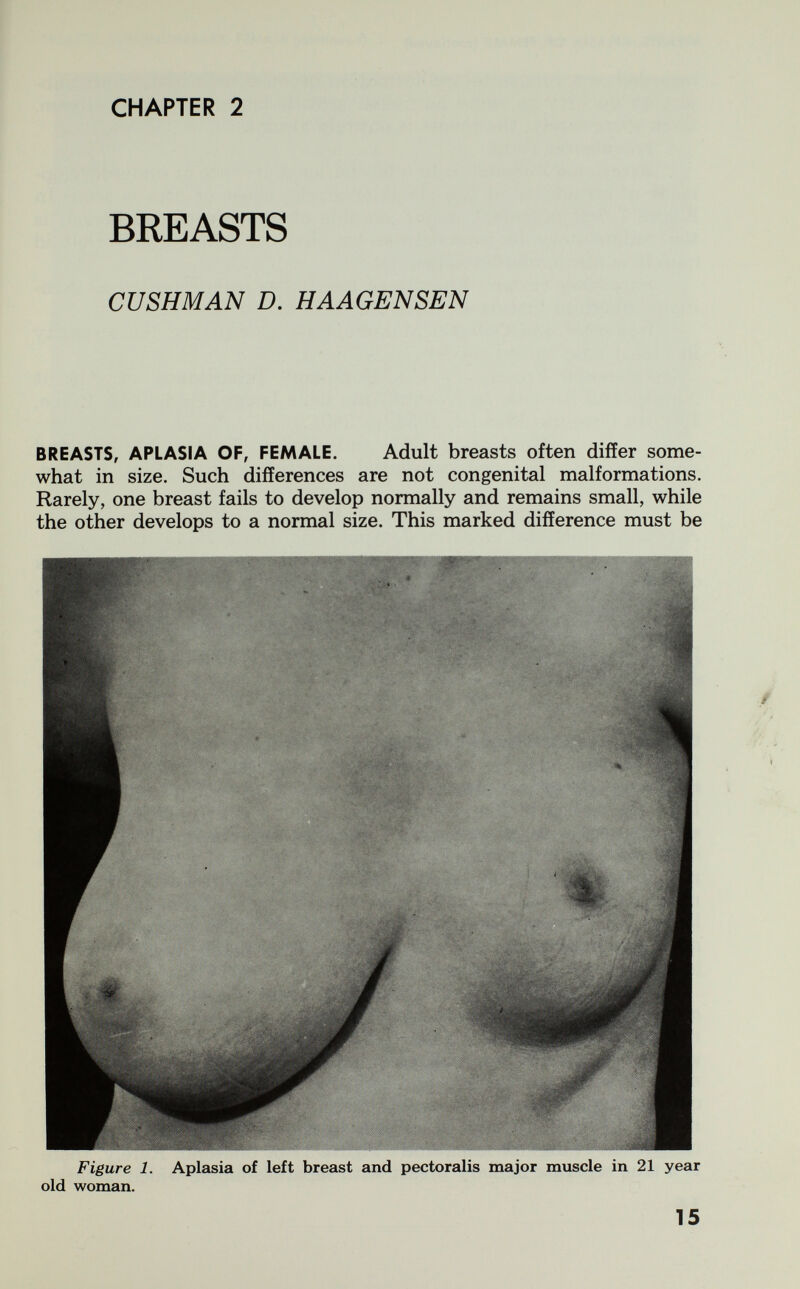 CHAPTER 2 BREASTS CUSHMAN D, HAAGENSEN BREASTS, APLASIA OF, FEMALE. Adult breasts often differ some¬ what in size. Such differences are not congenital malformations. Rarely, one breast fails to develop normally and remains small, while the other develops to a normal size. This marked difference must be Figure 1. Aplasia of left breast and pectoralis major muscle in 21 year old woman. 15