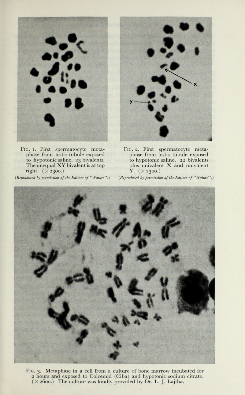 Fig. i. First spermatocyte meta- phase from testis tubule exposed to hypotonic saline. 23 bivalents. The unequal XY bivalent is at top right. ( X 2300.) {Reproduced by permission of the Editors of JVature.) J тш Fig. 2. First spermatocyte meta- phase from testis tubule exposed to hypotonic saline. 22 bivalents plus univalent X and univalent Y. (X2300.) {R(produced by permission of the Editors of Nature'.) Fig. 3. Metaphase in a cell from a culture of bone marrow incubated for 2 hours and exposed to Colcemid (Ciba) and hypotonic sodium citrate, (x 2600.) The culture was kindly provided by Dr. L. J. Lajtha,