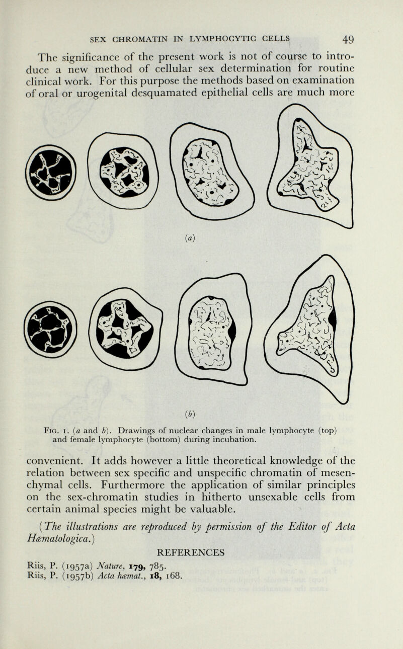 SEX CHROMATIN IN LYMPHOCYTIC CELLS 49 The significance of the present work is not of course to intro¬ duce a new method of cellular sex determination for routine clinical work. For this purpose the methods based on examination of oral or urogenital desquamated epithelial cells are much more (ö) (¿) Fig. i. (a and b). Drawings of nuclear changes in male lymphocyte (top) and female lymphocyte (bottom) during incubation. convenient. It adds however a little theoretical knowledge of the relation between sex specific and unspecific chromatin of mesen¬ chymal cells. Furthermore the application of similar principles on the sex-chromatin studies in hitherto unsexable cells from certain animal species might be valuable. ( The illustrations are reproduced by permission of the Editor of Acta Hamatologica.) REFERENCES Riis, P. (1957a) Nature, 179, 785. Riis, P. (1957b) Acta hismat., 18, 168.