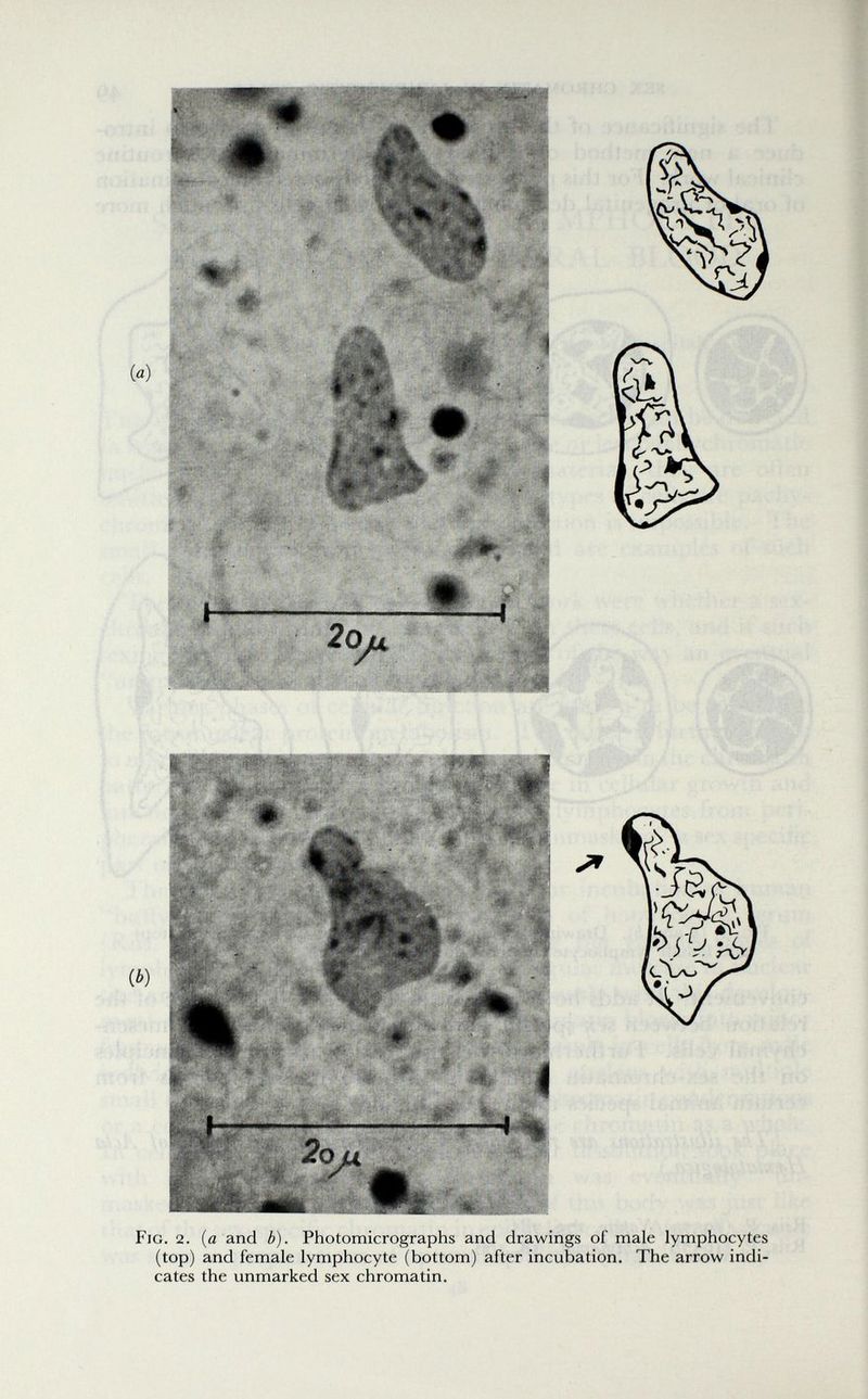 Fig. 2. {a and b). Photomicrographs and drawings of male lymphocytes (top) and female lymphocyte (bottom) after incubation. The arrow indi¬ cates the unmarked sex chromatin.