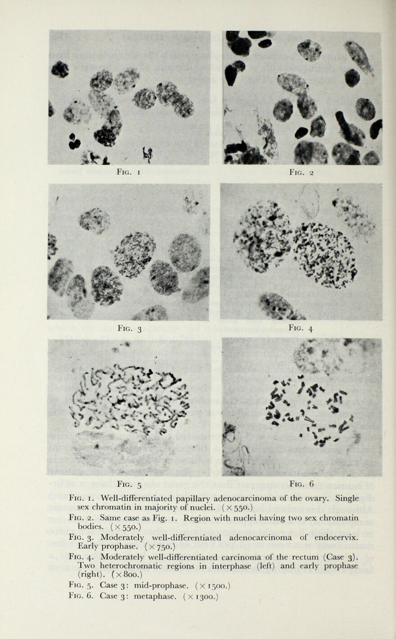 •»УййКь Fig. 3 Fig. 4 i » , ^ jT^# r- pk -tíi'i'' - T' - Ii \ 'V « < Л 'Г, ;m Í -, ^}-i - . Г.Ч S А л^ Чи '«» .<r ж n j Til-I Fig. 6 Fig. 5 Fig. i. Well-differentiated papillary adenocarcinoma of the ovary. Single sex chromatin in majority of nuclei. (X550-) Fig. 2. Same case as Fig. i. Region with nuclei having two sex chromatin bodies. ( X 550.) Fig. 3. Moderately well-differentiated adenocarcinoma of endocervix. Early prophase. ( X 750.) Fig. 4. Moderately well-differentiated carcinoma of the rectum (Case 3). Two heterochromatic regions in interphase (left) and early prophase (right). (x8oo.) Fig. 5. Сазез: mid-prophase. (x1500.) Fig. 6. Case 3: metaphase. (x1300.)