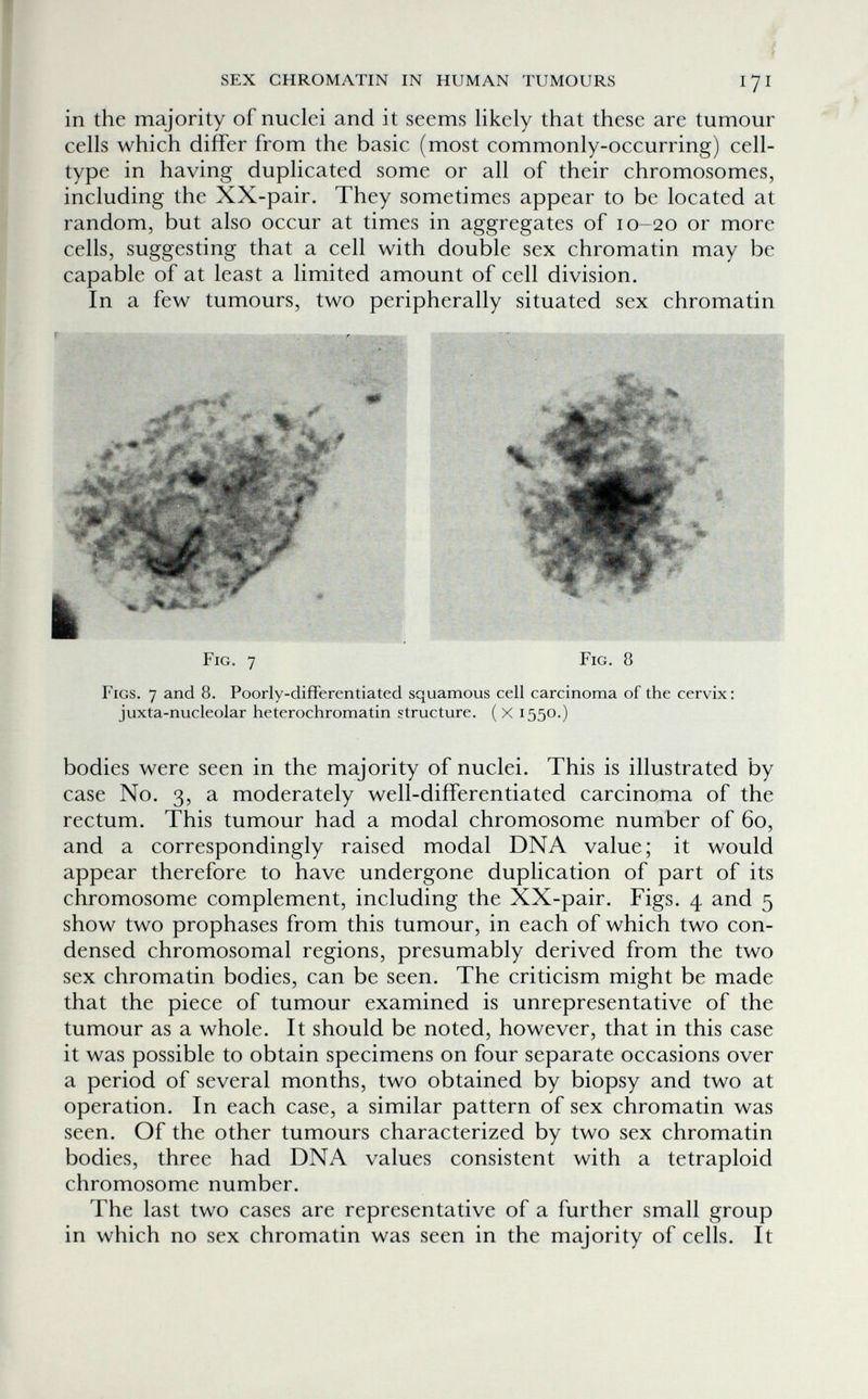 ì SEX CHROMATIN IN HUMAN TUMOURS I7I in the majority of nuclei and it seems likely that these are tumour cells which differ from the basic (most commonly-occurring) cell- type in having duplicated some or all of their chromosomes, including the XX-pair. They sometimes appear to be located at random, but also occur at times in aggregates of 10-20 or more cells, suggesting that a cell with double sex chromatin may be capable of at least a limited amount of cell division. In a few tumours, two peripherally situated sex chromatin Fig. 7 Fig. 8 Figs. 7 and 8. Poorly-differentiated squamous cell carcinoma of the cervix: juxta-nucleolar heterochromatin structure. ( X 1550.) bodies were seen in the majority of nuclei. This is illustrated by case No. 3, a moderately well-differentiated carcinoma of the rectum. This tumour had a modal chromosome number of 60, and a correspondingly raised modal DNA value; it would appear therefore to have undergone duplication of part of its chromosome complement, including the XX-pair. Figs. 4 and 5 show two prophases from this tumour, in each of which two con¬ densed chromosomal regions, presumably derived from the two sex chromatin bodies, can be seen. The criticism might be made that the piece of tumour examined is unrepresentative of the tumour as a whole. It should be noted, however, that in this case it was possible to obtain specimens on four separate occasions over a period of several months, two obtained by biopsy and two at operation. In each case, a similar pattern of sex chromatin was seen. Of the other tumours characterized by two sex chromatin bodies, three had DNA values consistent with a tetraploid chromosome number. The last two cases are representative of a further small group in which no sex chromatin was seen in the majority of cells. It