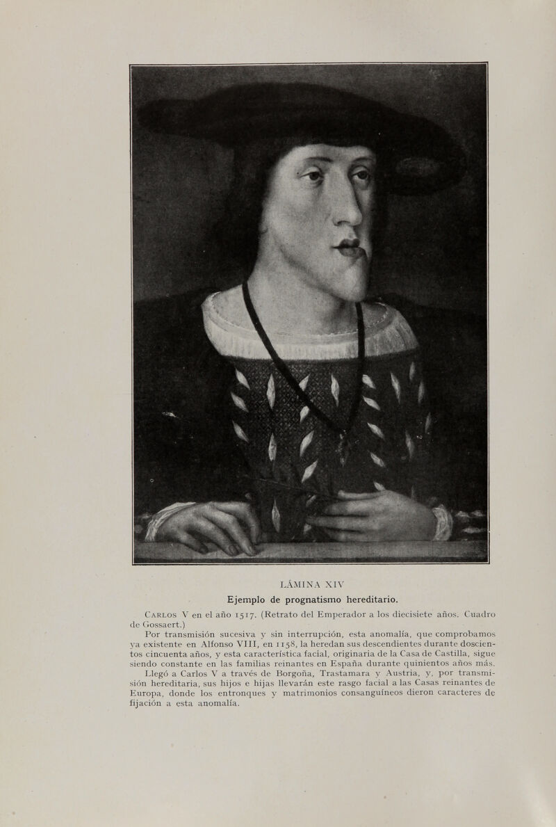 LÁMINA XIV Ejemplo de prognatismo hereditario. Carlos V en el año 1517. (Retrato del Emperador a los diecisiete años. Cuadro de Gossaert.) Por transmisión sucesiva y sin interrupción, esta anomalía, que comprobamos ya existente en Alfonso VIII, en 1158, la heredan sus descendientes durante doscien¬ tos cincuenta años, y esta característica facial, originaria de la Casa de Castilla, sigue siendo constante en las familias reinantes en España durante quinientos años más. Llegó a Carlos V a través de Borgoña, Trastamara y Austria, y, por transmi¬ sión hereditaria, sus hijos e hijas llevarán este rasgo facial a las Casas reinantes de Europa, donde los entronques y matrimonios consanguíneos dieron caracteres de fijación a esta anomalía.