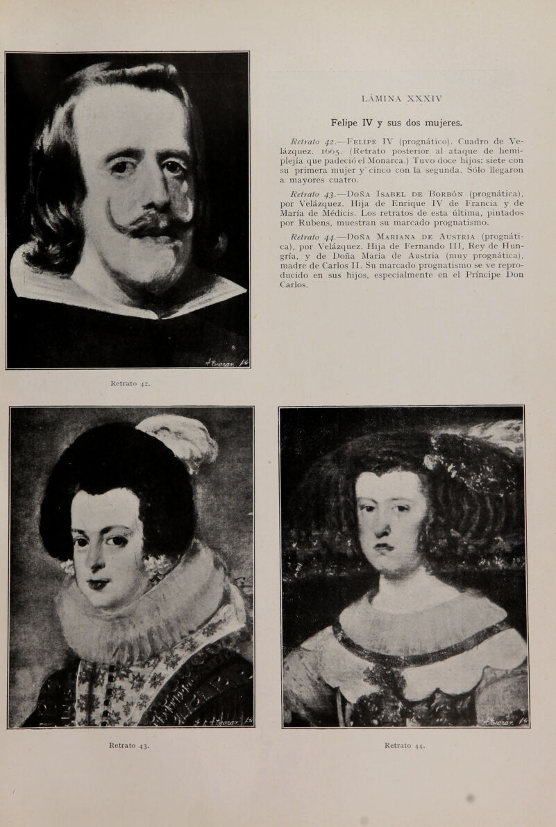 LÁMINA XXXIV Felipe IV y sus dos mujeres. Retrato 42.—I'elipe IV (prognàtico). Cuadro de Ve- lázquez. (Retrato posterior al ataque de hemi¬ plejía que padeció el Monarca.) Tuvo doce hijos: siete con su primera mujer y cinco con la segunda. Sólo llegaron a mayores cuatro. Retrato 43.—Doña Isabel de Borbón (prognàtica), por Velázquez. Hija de Enrique IV de Francia y de María de Médicis. Los retratos de esta i'iltima, pintados por Rubens, muestran su marcado prognatismo. Retrato 44.—Doña Mariana de Austria (prognáti- ca), por Velázquez. Hija de Fernando III, Rey de Hun¬ gría, y de Doña María de Austria (muy prognàtica), madre de Carlos II. Su marcado prognatismo se ve repro¬ ducido en sus hijos, especialmente en el Príncipe Don Carlos. Kotrato 42.