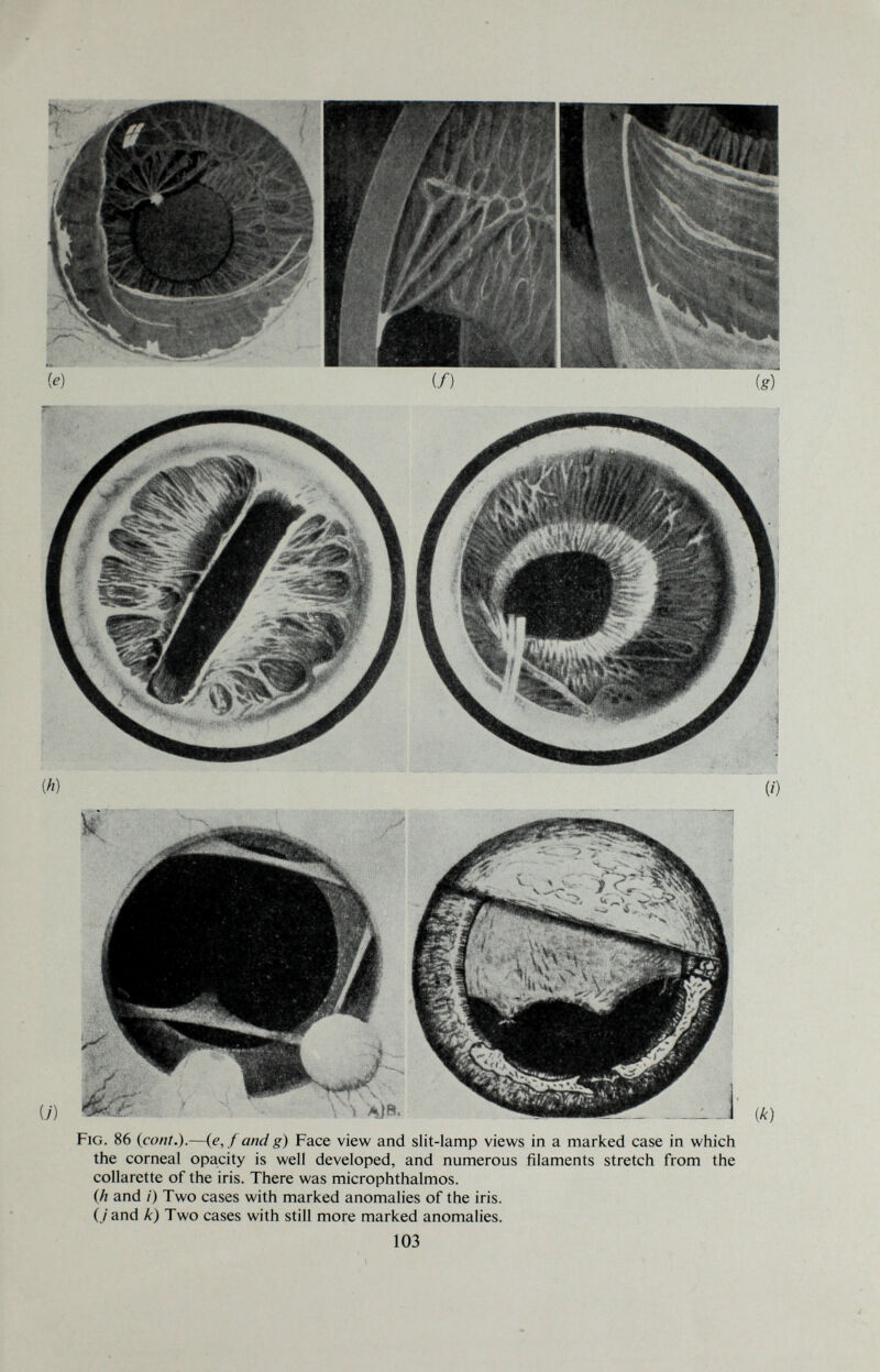 Fig. 86 {coni.).—(e, f and g) Face view and slit-lamp views in a marked case in which the corneal opacity is well developed, and numerous filaments stretch from the collarette of the iris. There was microphthalmos. (A and /) Two cases with marked anomalies of the iris. (/and k) Two cases with still more marked anomalies. 103
