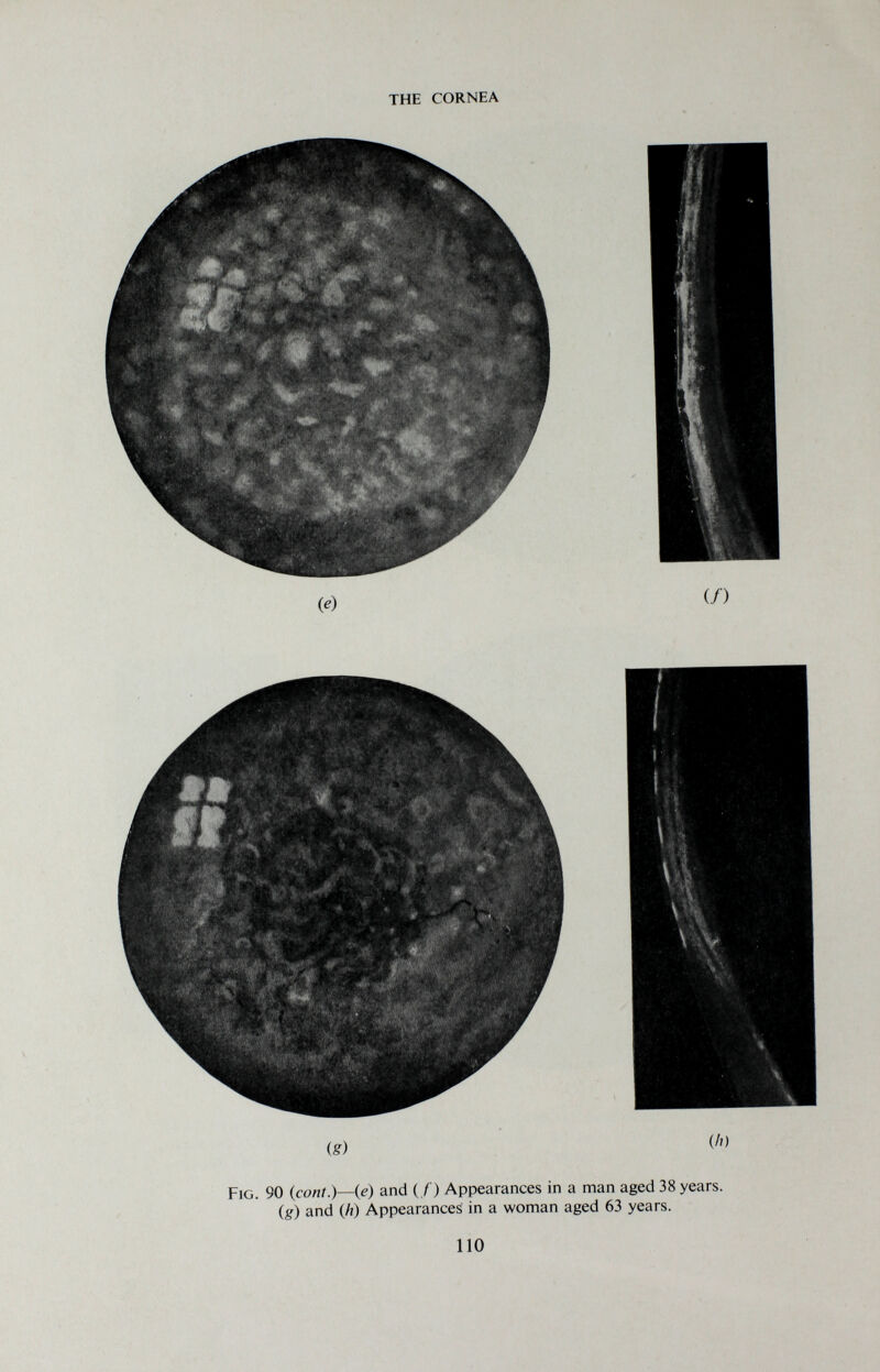 THE CORNEA (^) (/) (g) (Л) Fig. 90 {conl.)~{e) and (/) Appearances in a man aged 38 years. (^) and (A) Appearances in a woman aged 63 years. 110