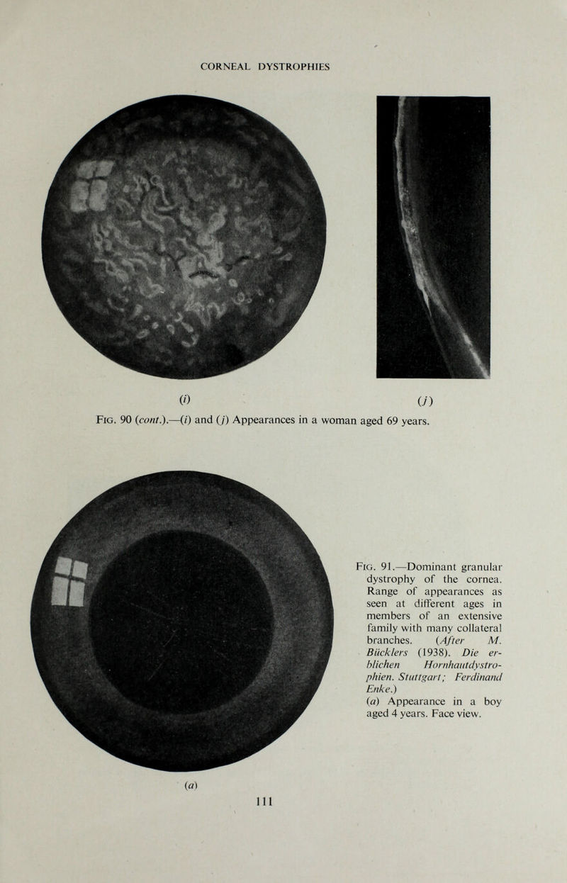 \ CORNEAL DYSTROPHIES (О (Л Fig. 90 (cont).—(/) and (/) Appearances in a woman aged 69 years. Fig. 91.—Dominant granular dystrophy of the cornea. Range of appearances as seen at different ages in members of an extensive family with many collateral branches. {After M. Bucklers (1938). Die er¬ blichen Hornhaiitdystro- phien. Stuttgart; Ferdinand Enke.) iq) Appearance in a boy aged 4 years. Face view. (a) ill
