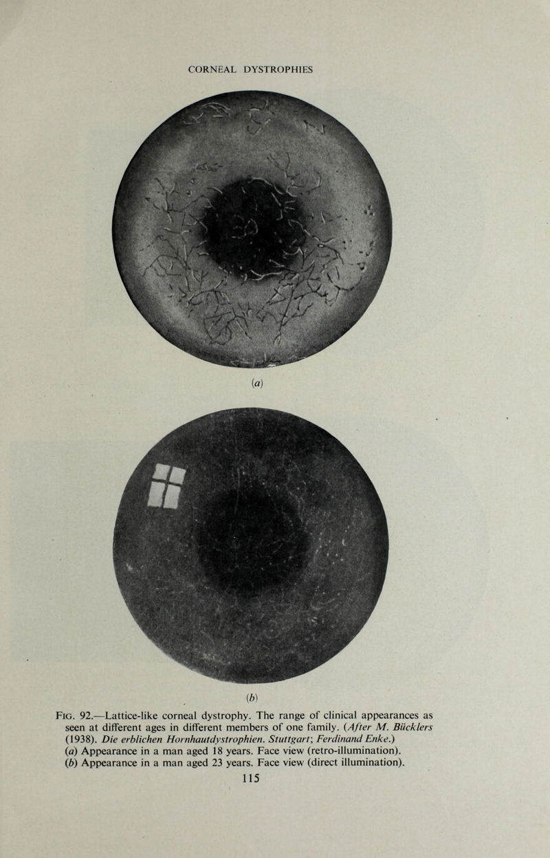 CORNEAL DYSTROPHIES ib) Fig. 92.—Lattice-like corneal dystrophy. The range of clinical appearances as seen at different ages in different members of one family. (After M. Bucklers (1938). Die erblichen Hornhautdystrophien. Stuttgart, Ferdinand Enke.) {a) Appearance in a man aged 18 years. Face view (retro-illumination). (b) Appearance in a man aged 23 years. Face view (direct illumination). 115