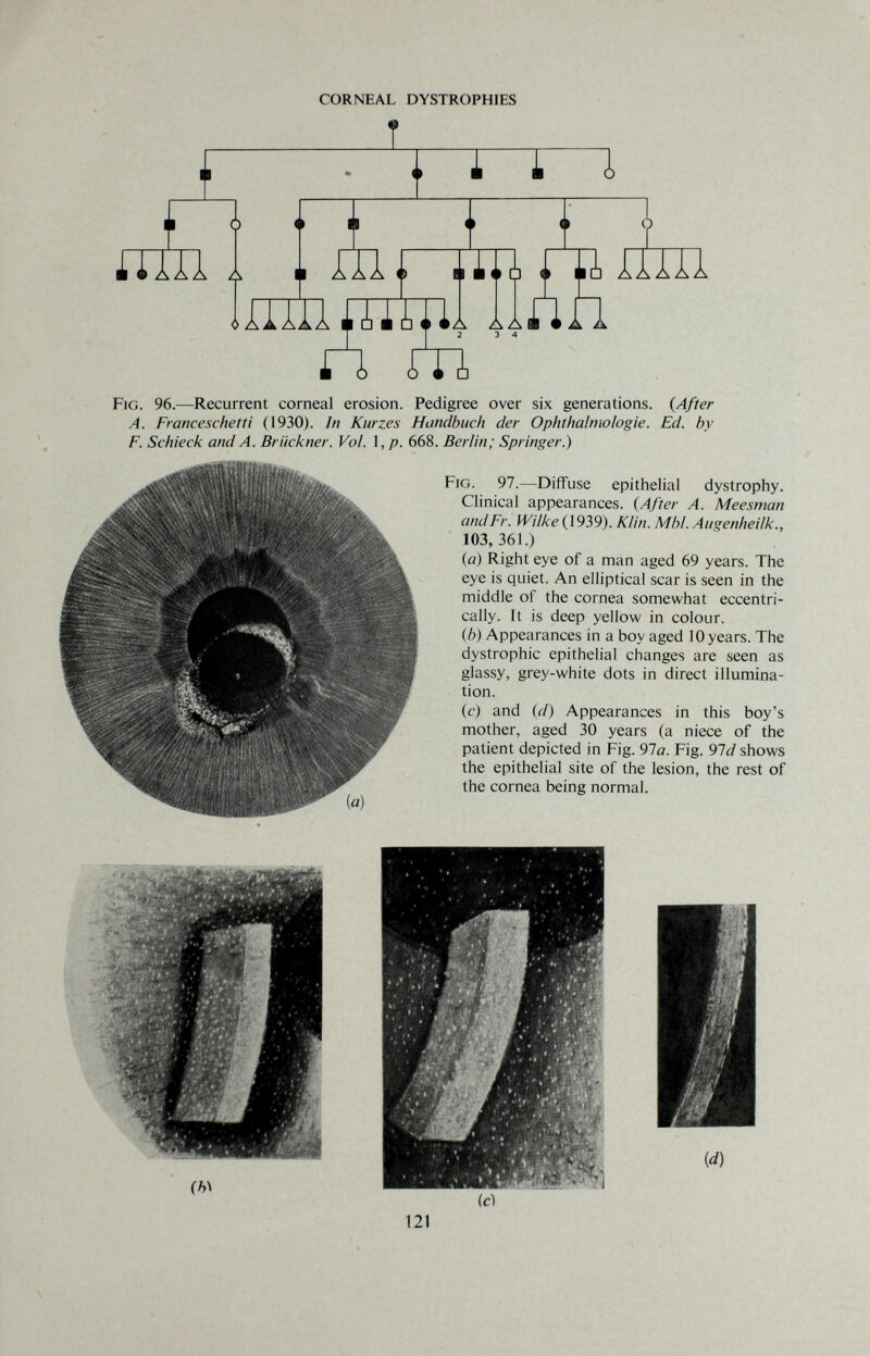 CORNEAL DYSTROPHIES Fig. 96.—Recurrent corneal erosion. Pedigree over six generations. {After A. Franceschetti (1930). In Kurzes Handbuch der Ophthalmologie. Ed. by F. Schieck and A. Brückner. Vol. \,p. 668. Berlin; Springer.) Fig. 97.—Diffuse epithelial dystrophy. Clinical appearances. {After A. Meesman andFr. Wilke {192,9). Klin. МЫ. Augenheilk., 103, 361.) {a) Right eye of a man aged 69 years. The eye is quiet. An elliptical scar is seen in the middle of the cornea somewhat eccentri¬ cally. It is deep yellow in colour. {b) Appearances in a boy aged 10 years. The dystrophic epithelial changes are seen as glassy, grey-white dots in direct illumina¬ tion. (c) and {d) Appearances in this boy's mother, aged 30 years (a niece of the patient depicted in Fig. 91a. Fig. 91 d shows the epithelial site of the lesion, the rest of the cornea being normal.