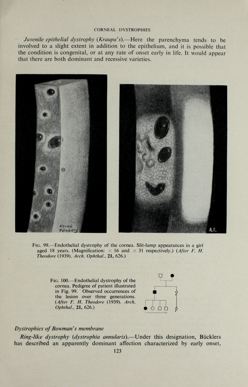 CORNEAL DYSTROPHIES Juvenile epithelial dystrophy (Kraupa's).—Here the parenchyma tends to be involved to a shght extent in addition to the epithelium, and it is possible that the condition is congenital, or at any rate of onset early in life. It would appear that there are both dominant and recessive varieties. Fig. 99.—Endothelial dystrophy of the cornea. Slit-lamp appearances in a girl aged 18 years. (Magnification: X 16 and X 31 respectively.) (After F. H. Theodore (1939). Arch. Ophthal., 21, 626.) Fig. 100.—Endothelial dystrophy of the cornea. Pedigree of patient illustrated in Fig. 99. Observed occurrences of the lesion over three generations. {After F. H. Theodore (1939). Arch. Ophtha!., 21, 626.) ir -С/ Ш , Dystrophies of Bowman's membrane Ring-like dystrophy {dystrophia annularis}.—Under this designation, Biicklers has described an apparently dominant affection characterized by early onset, 123