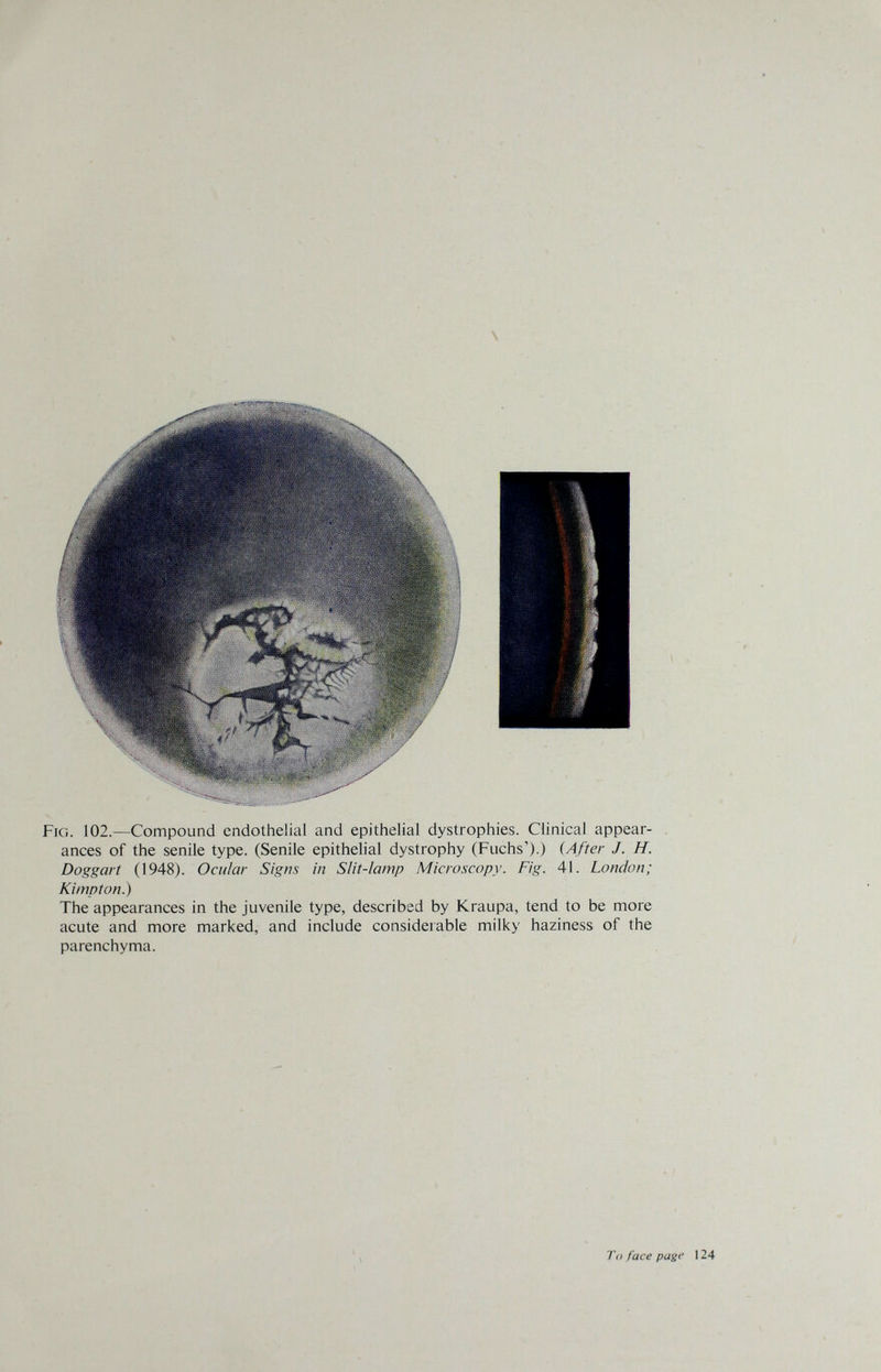 Fig. 102.—Compound endothelial and epithelial dystrophies. Clinical appear- , anees of the senile type. (Senile epithelial dystrophy (Fuchs').) {After J. H. Doggart (1948). Ocular Signs in Slit-lamp Microscopy. Fig. 41. London; Kimpton.) The appearances in the juvenile type, described by Kraupa, tend to be more acute and more marked, and include considerable milky haziness of the parenchyma. Ti) face page 124 ■r г
