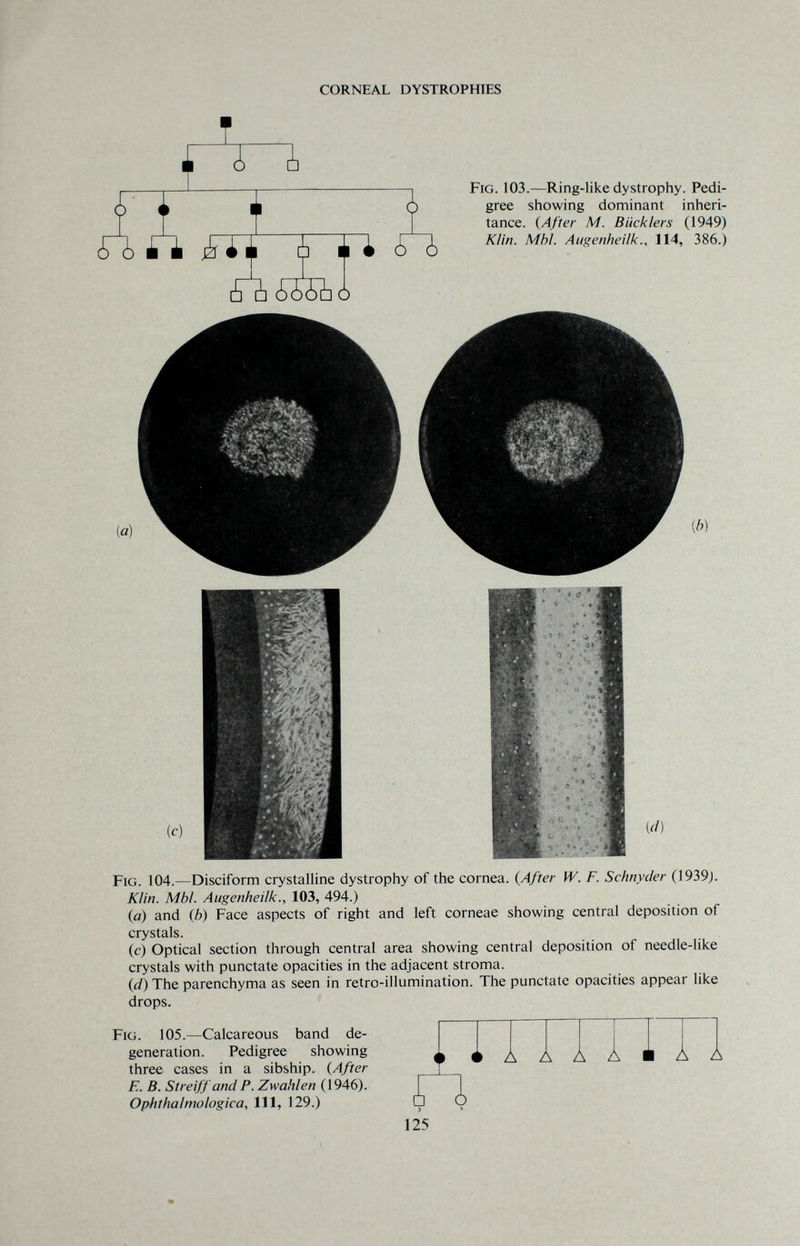CORNEAL DYSTROPHIES т А ¿it ò Fig. 103.—Ring-like dystrophy. Pedi¬ gree showing dominant inheri¬ tance. (After M. Bucklers (1949) Klin. Mhl. Augenheilk., 114, 386.) Fig. 104.—Disciform crystalline dystrophy of the cornea. (After W. F. Schnyder (1939). Klin. МЫ. Augenheilk., 103, 494.) (a) and (b) Face aspects of right and left corneae showing central deposition of crystals. (c) Optical section through central area showing central deposition of needle-like crystals with punctate opacities in the adjacent stroma. (i/) The parenchyma as seen in retro-illumination. The punctate opacities appear like drops. Fig. 105.—Calcareous band de¬ generation. Pedigree showing three cases in a sibship. (After E. B. Streiffand P. Zwahlen (1946). Ophthalmologic a. 111, 129.) Ä A Ä A A О 125