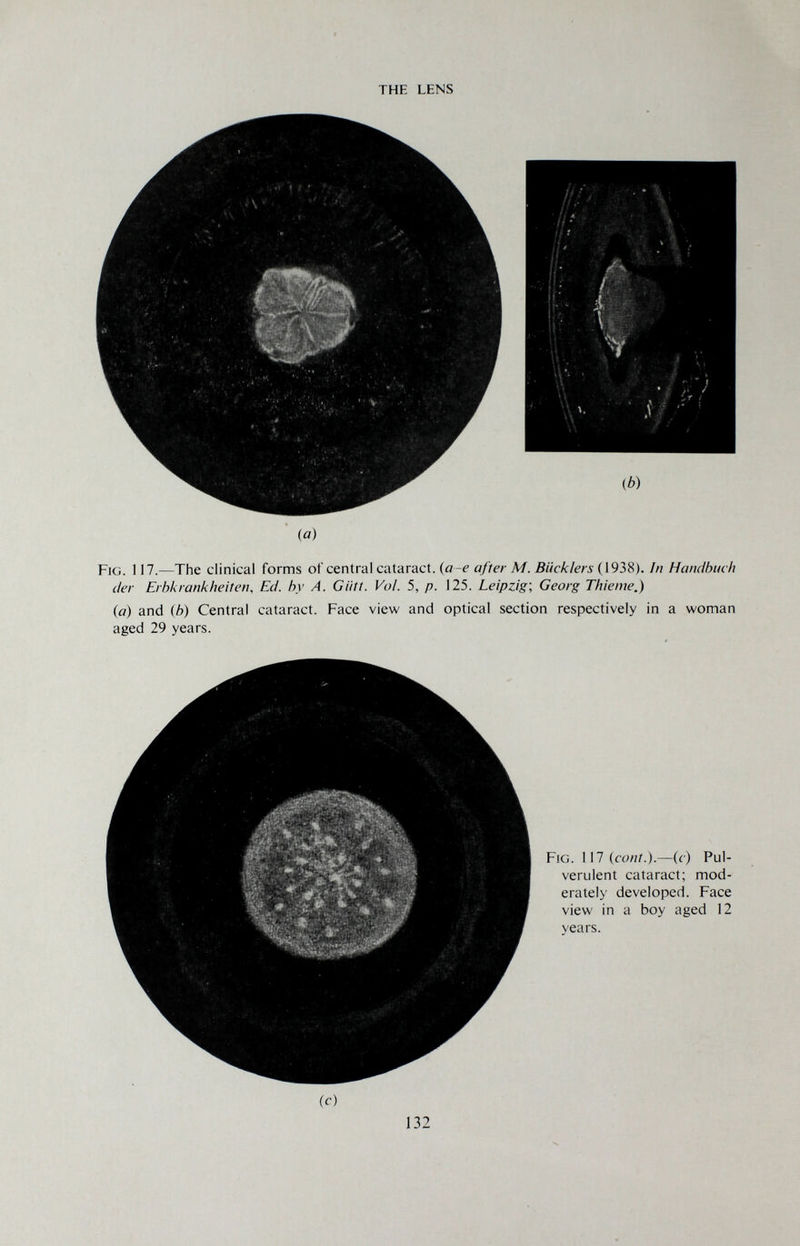 THE LENS ib) (а) Fig. 117.—The clinical forms of central cataract, (a-e after M. Biicklers (1938). In Handbuch iter Erbkrankheiten, Ed. by A. Giitt. Vol. 5, p. 125. Leipzig, Georg Thieme.) {a) and (b) Central cataract. Face view and optical section respectively in a woman aged 29 years. Fig. 117 (cont.).—(c) Pul¬ verulent cataract; mod¬ erately developed. Face view in a boy aged 12 vears. (c) 132