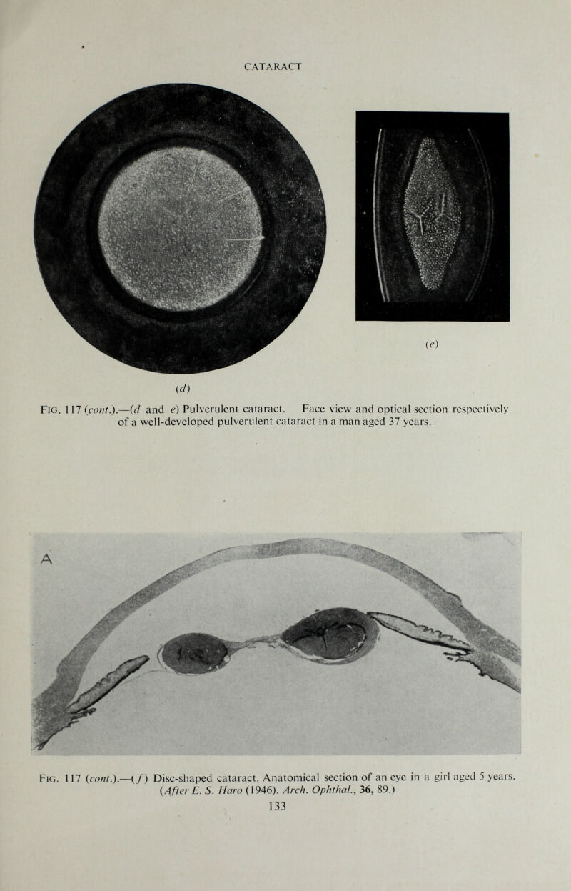 CATARACT id) Fig. 117 (cant.).—(d and e) Pulverulent cataract. Face view and optical section respectively of a well-developed pulverulent cataract in a man aged 37 years. Fig. 117 {coni.).—(/) Disc-shaped cataract. Anatomical section of an eye in a girl aged 5 years. (After E. S. Haro (1946). Arc/i. Ophthal., 36, 89.) 133