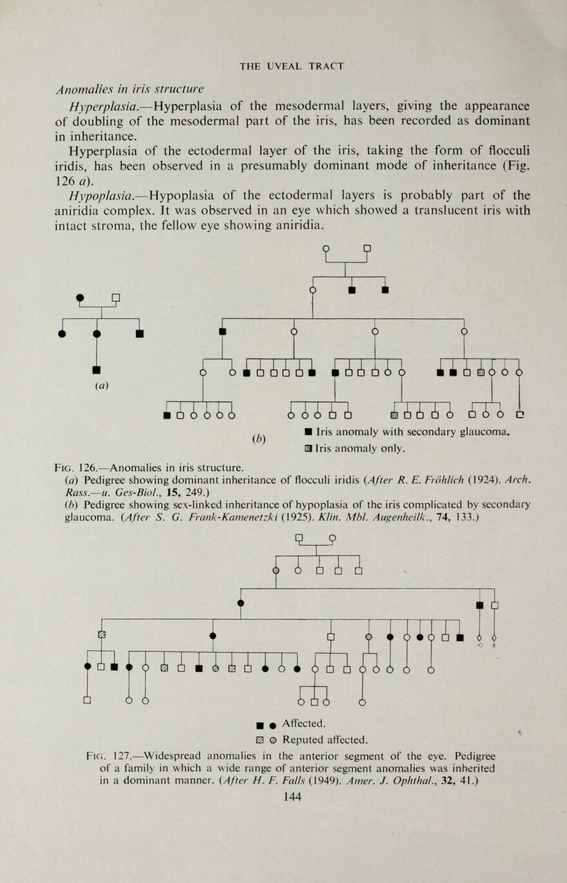THE UVEAL TRACT Anomalies in iris structure Hyperplasia.—Hyperplasia of the mesodermal layers, giving the appearance of doubling of the mesodermal part of the iris, has been recorded as dominant in inheritance. Hyperplasia of the ectodermal layer of the iris, taking the form of flocculi iridis, has been observed in a presumably dominant mode of inheritance (Fig. 126 a). Hypoplasia.—Hypoplasia of the ectodermal layers is probably part of the aniridia complex. It was observed in an eye which showed a translucent iris with intact stroma, the fellow eye showing aniridia. Fig. 126.^—Anomalies in iris structure. {a) Pedigree showing dominant inheritance of flocculi iridis {After R. E. Fröhlich (1924). Arch. Rass.—u. Ges-Biol., 15, 249.) (h) Pedigree showing sex-linked inheritance of hypoplasia of the iris complicated by secondary glaucoma. (After S. G. Frank-Kamenetzki (1925). KVm. МЫ. Augenheilk., 74, 133.) ■ Ф Affected. 0 @ Reputed affected. FiCi. 127.—Widespread anomalies in the anterior segment of the eye. Pedigree of a family in which a w ide range of anterior segment anomalies was inherited in a dominant manner. (After H. F. Falls (1949). Amer. J. Ophthal., 32, 41.) 144
