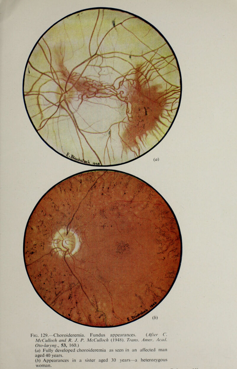Fig. 129.—Choroideremia. Fundus appearances. {After C. McCulloch and R. J. P. McCiilloch (1948). Trans. Anier. Acad. Oto-Iaryng., 53, 160.) («) Fully developed choroideremia as seen in an aflected man aged 40 years. (Л) Appearances in a sister aged 30 years—a heterozygous woman.