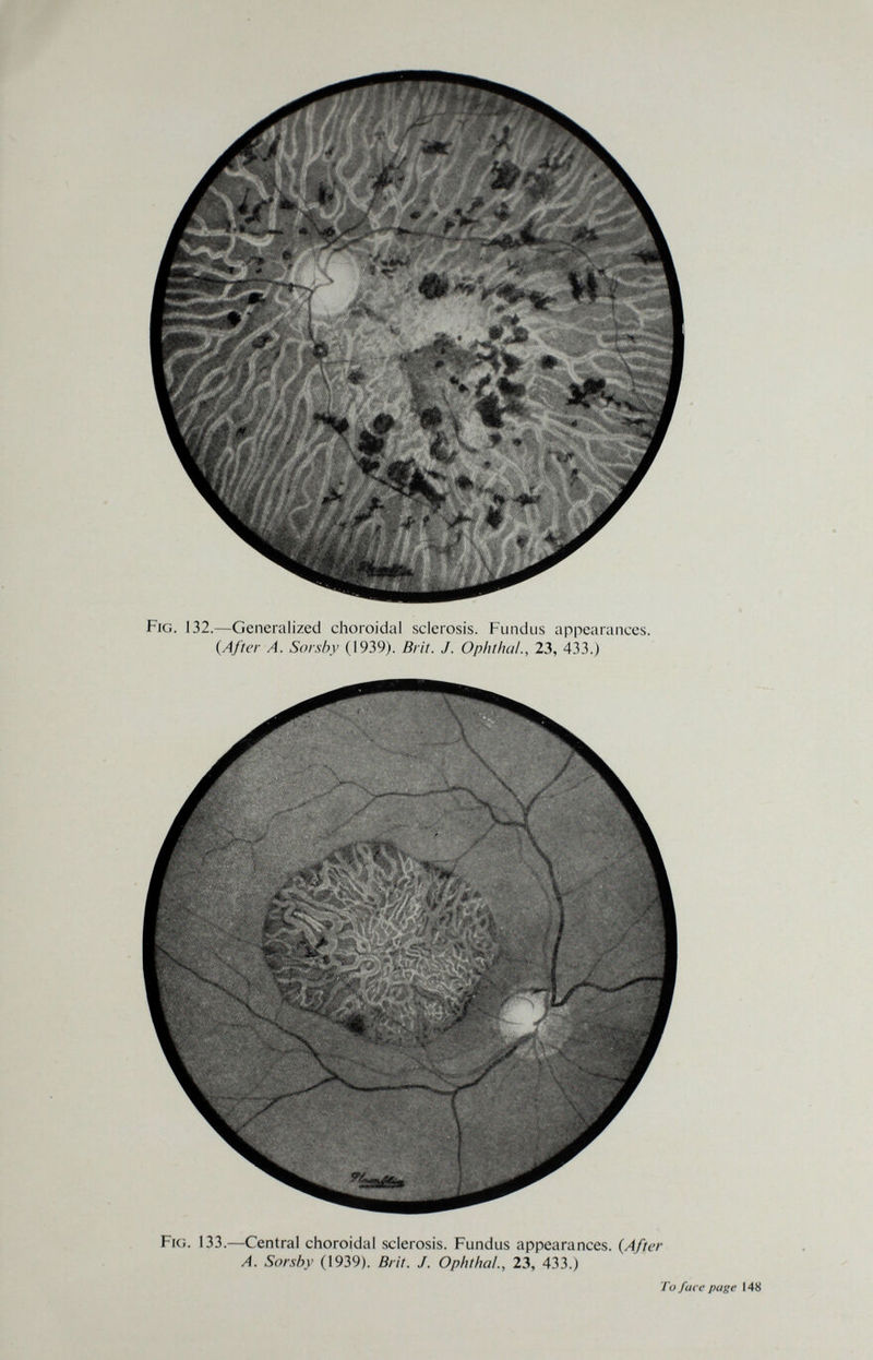 Fig. 132.—Generalized choroidal sclerosis. Fundus appearances. {After A. Sorsby (1939). Brit. J. Ophthal., 23, 433.) Fig. 133.—Central choroidal sclerosis. Fundus appearances. (After A. Sorsby (1939). Brit. J. Ophtha!., 23, 433.) To face page 148