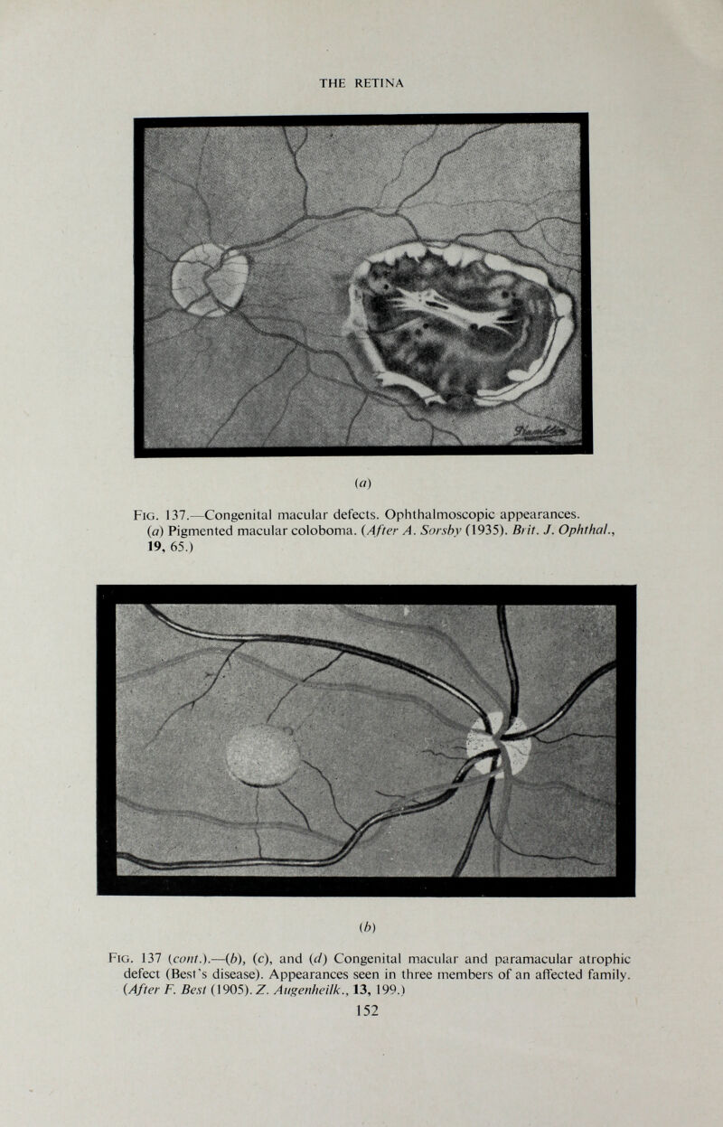 THE RETINA (Я) Fig. 137.—Congenital macular defects. Ophthalmoscopic appearances. (a) Pigmented macular coloboma. {After A. Sorsby (1935). Brit. J. Ophthal., 19, 65.) (b) Fig. 137 i^cont.).—{b), (c), and (d) Congenital macular and paramacular atrophic defect (Best's disease). Appearances seen in three members of an affected family. (After F. Best (1905). Z. Augenheilk., 13, 199.) 152