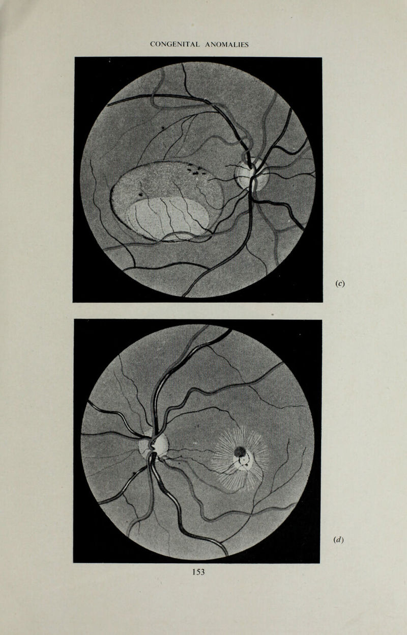 CONGENITAL ANOMALIES 153