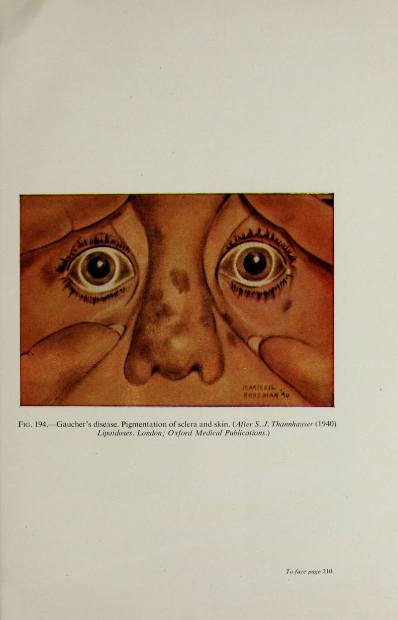Fig. 194.—Gaucher's disease. Pigmentation of sclera and skin. {After S. J. Thaiinluiuser (1940) Lipoidoses. London; Oxford Medical Publications.) i To face page 210