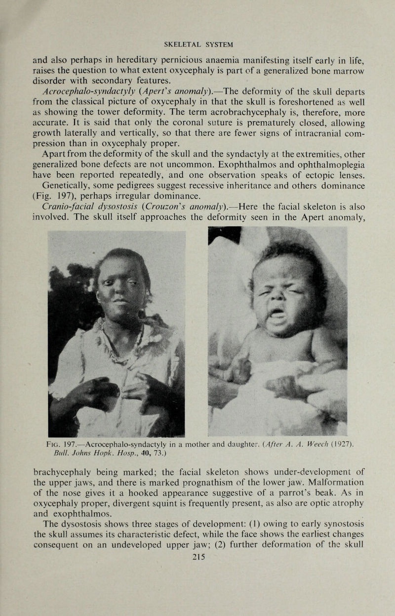 SKELETAL SYSTEM and also perhaps in hereditary pernicious anaemia manifesting itself early in life, raises the question to what extent oxycephaly is part of a generalized bone marrow disorder with secondary features. Acrocephalosyndactyly {Aperfs anomaly).—The deformity of the skull departs from the classical picture of oxycephaly in that the skull is foreshortened as well as showing the tower deformity. The term acrobrachycephaly is, therefore, more accurate. It is said that only the coronal suture is prematurely closed, allowing growth laterally and vertically, so that there are fewer signs of intracranial com¬ pression than in oxycephaly proper. Apart from the deformity of the skull and the syndactyly at the extremities, other generalized bone defects are not uncommon. Exophthalmos and ophthalmoplegia have been reported repeatedly, and one observation speaks of ectopic lenses. Genetically, some pedigrees suggest recessive inheritance and others dominance (Fig. 197), perhaps irregular dominance. Cranio-facial dysostosis {Crouzon's anomaly^.—Here the facial skeleton is also involved. The skull itself approaches the deformity seen in the Apert anomaly, Fig. 197.—Acrocephalo-syndactyly in a mother and daughter. {After A. A. Weech (1927). Bull. Johns Hopk. Hosp., 40, 7.3.) brachycephaly being marked; the facial skeleton shows under-development of the upper jaws, and there is marked prognathism of the lower jaw. Malformation of the nose gives it a hooked appearance suggestive of a parrot's beak. As in oxycephaly proper, divergent squint is frequently present, as also are optic atrophy and exophthalmos. The dysostosis shows three stages of development: (1) owing to early synostosis the skull assumes its characteristic defect, while the face shows the earliest changes consequent on an undeveloped upper jaw; (2) further deformation of the skull 215